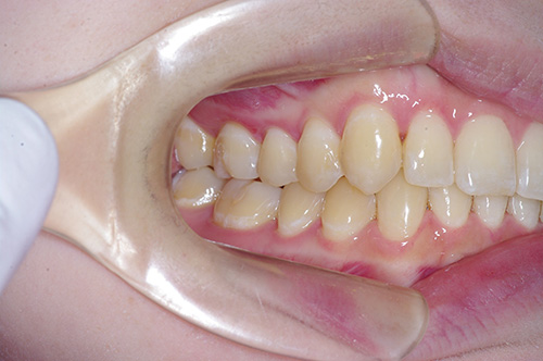 治療後・右側面